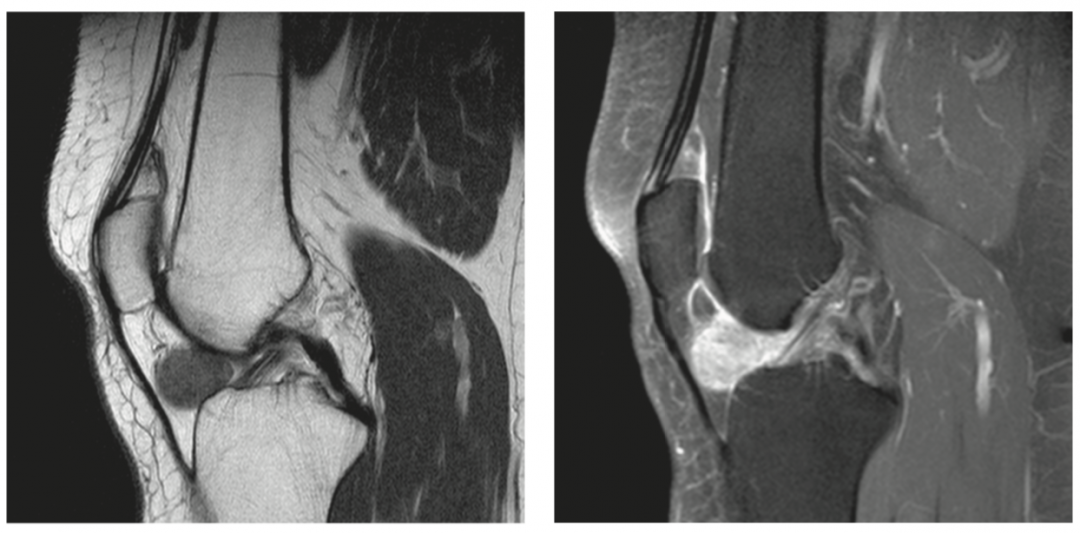 Tenosynovial Giant Cell Tumor (TGCT) | CheckRare