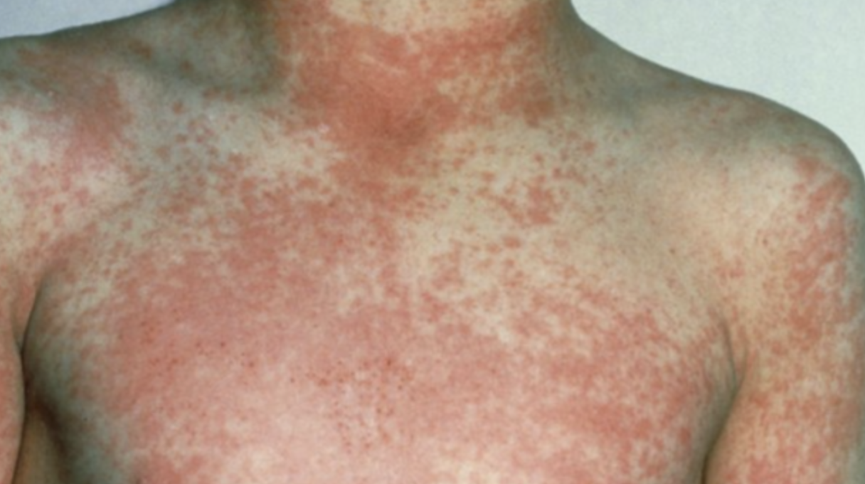 scarlet-fever-rheumatic-fever-checkrare