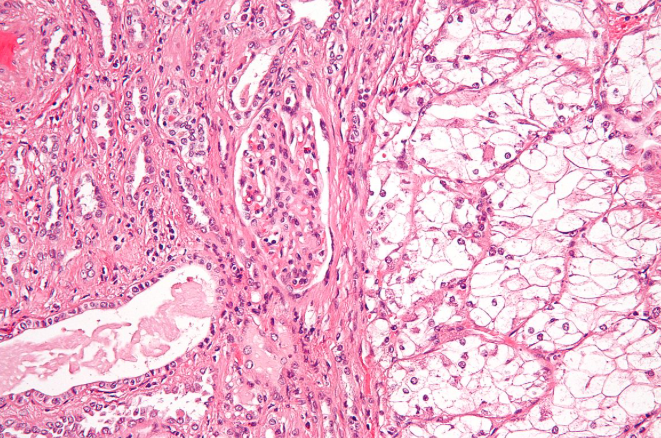 Positive Results in Patients with Clear Cell Renal Cell Carcinoma ...