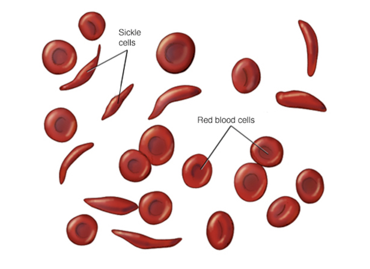 Sickle Cell Anemia CheckRare
