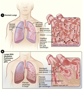 Idiopathic Pulmonary Fibrosis
