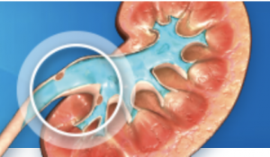 low-grade upper tract urothelial cancer