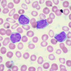 lymphocytic leukemia
